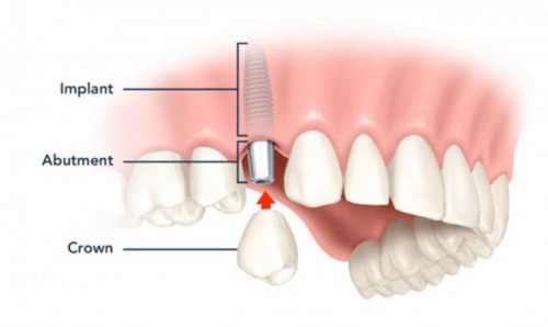 Trồng Implant khi bị mất 1 răng có được không?