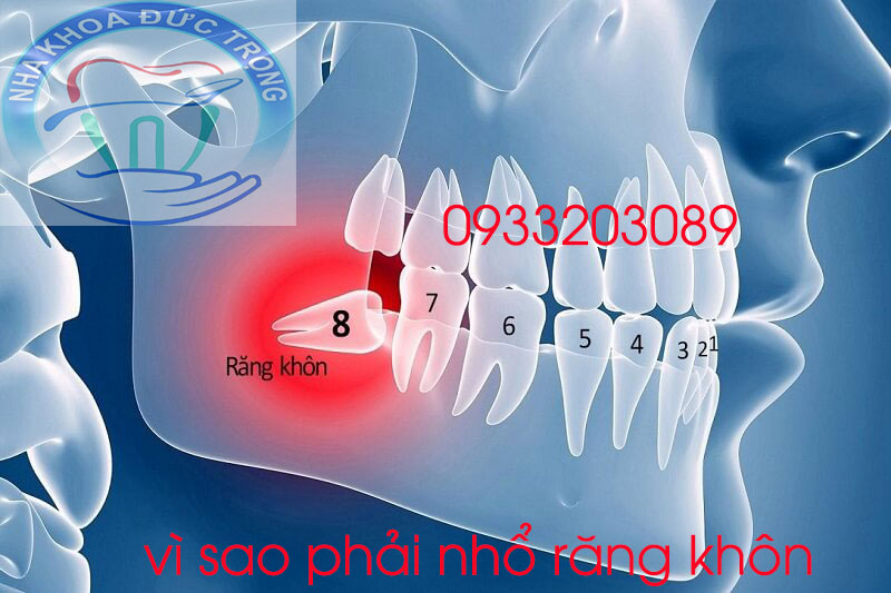 Tại sao cần phải nhổ răng số 8, nhổ răng khôn số 8 ở núi đèo Thủy Nguyên