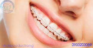Niềng răng mắc cài sứ là gi?