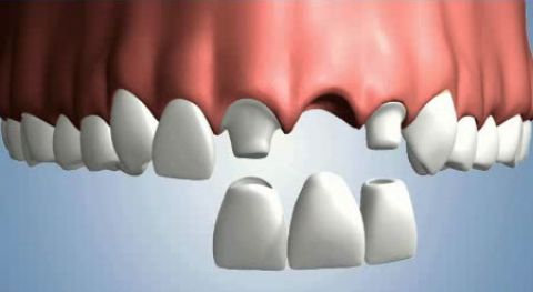 Làm cầu răng sứ tại Núi Đèo Thủy Nguyên