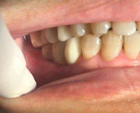 Hàm răng sau khi trồng implant