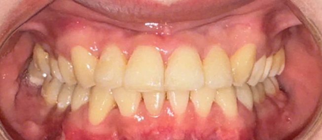 Hàm răng chị Thủy sau khi tháo mắc cài, đều và khít