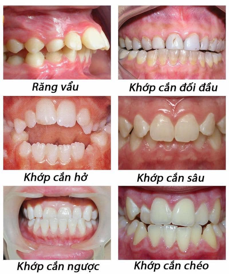 Niềng răng- chỉnh nha giá bao nhiêu?