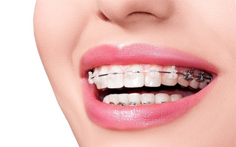 Thời gian niềng răng mất bao lâu thì hoàn tất?