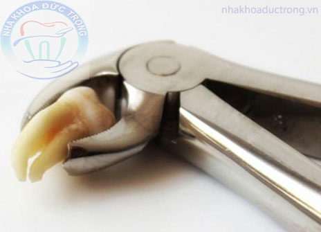 NHỔ RĂNG KHÔN (răng số 8) ở Núi Đèo Thủy Nguyên