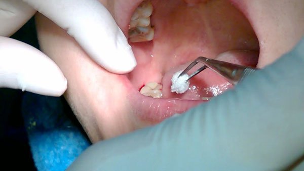 Hướng dẫn chăm sóc sau khi nhổ răng khôn - nhổ răng khôn tại núi đèo thủy nguyên