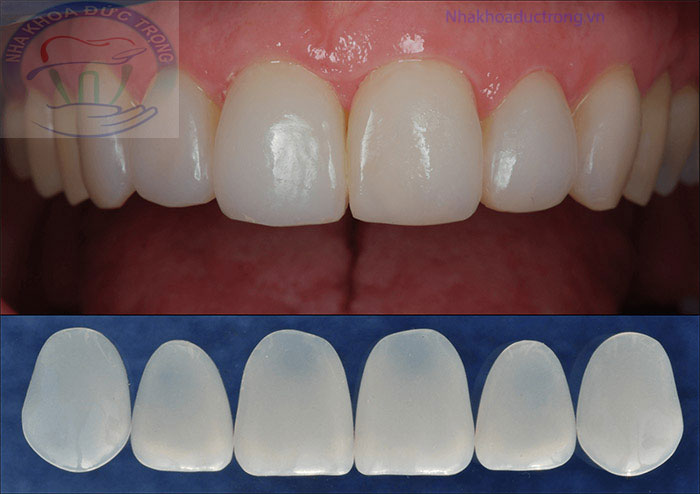 Dán sứ veneer ở Núi Đèo Thủy Nguyên
